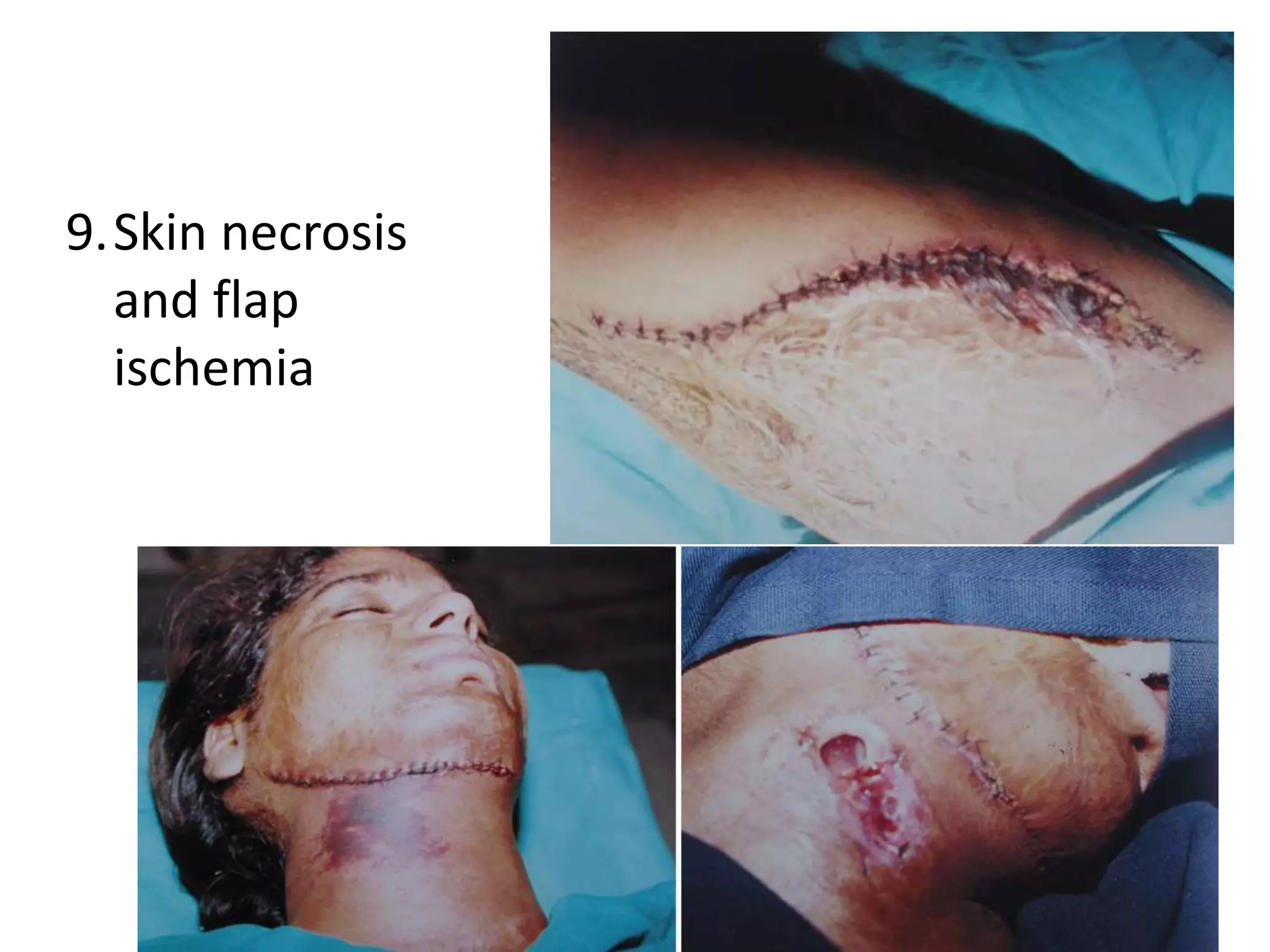 9.Skin necrosis
and flap
ischemia
 