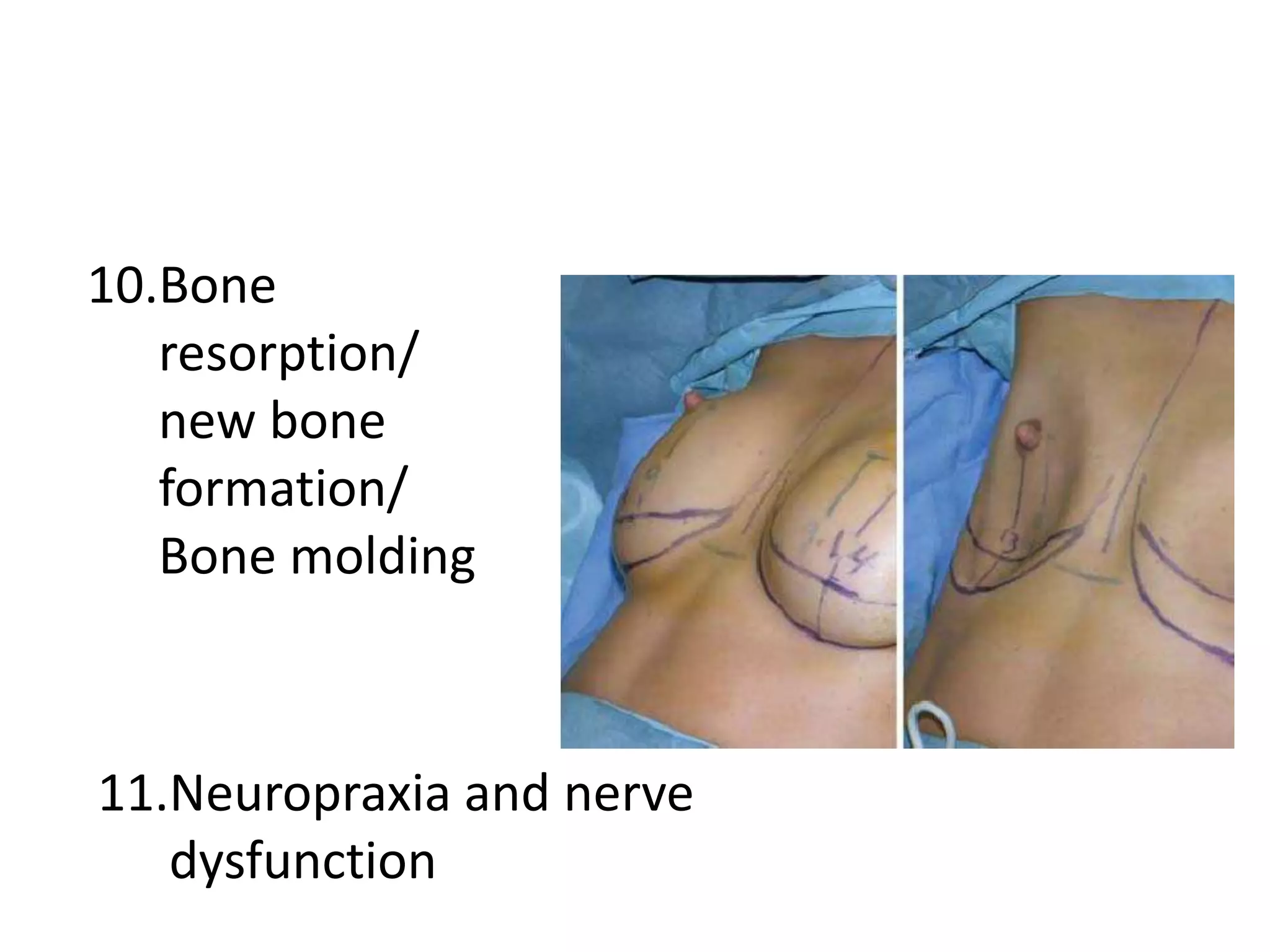10.Bone
resorption/
new bone
formation/
Bone molding
11.Neuropraxia and nerve
dysfunction
 