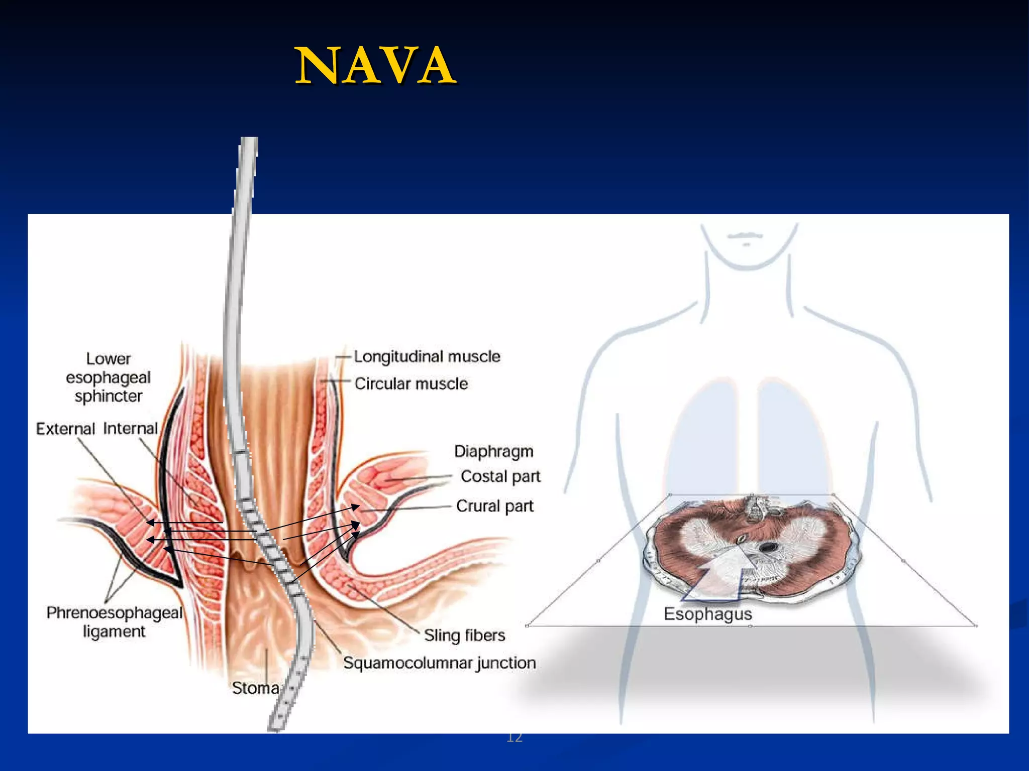 NAVA Esophagus 