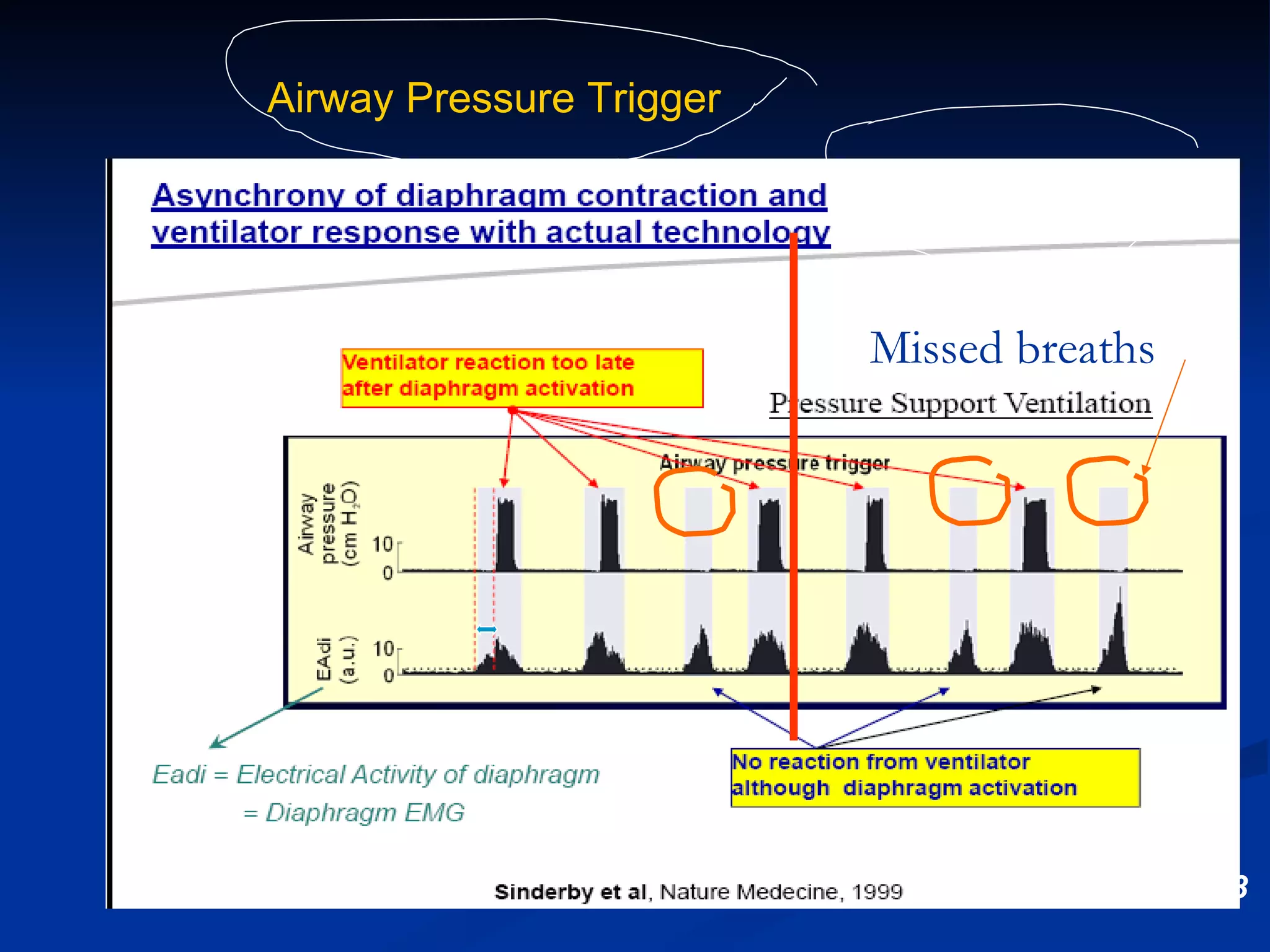 Sinderby et al, Nature Med 1999;5:1433 Time (s) 0 1 4 3 2 0 1 4 3 2 Airway Pressure Trigger Onset of diaphragmatic electrical activity Onset of ventilator flow Neural Trigger 0 20 -5.0 0.0 0.0 0.5 -1 0 1 Flow (l/s) Volume (l) P es (cm H 2 O) P aw (cm  H 2 O ) Missed breaths 