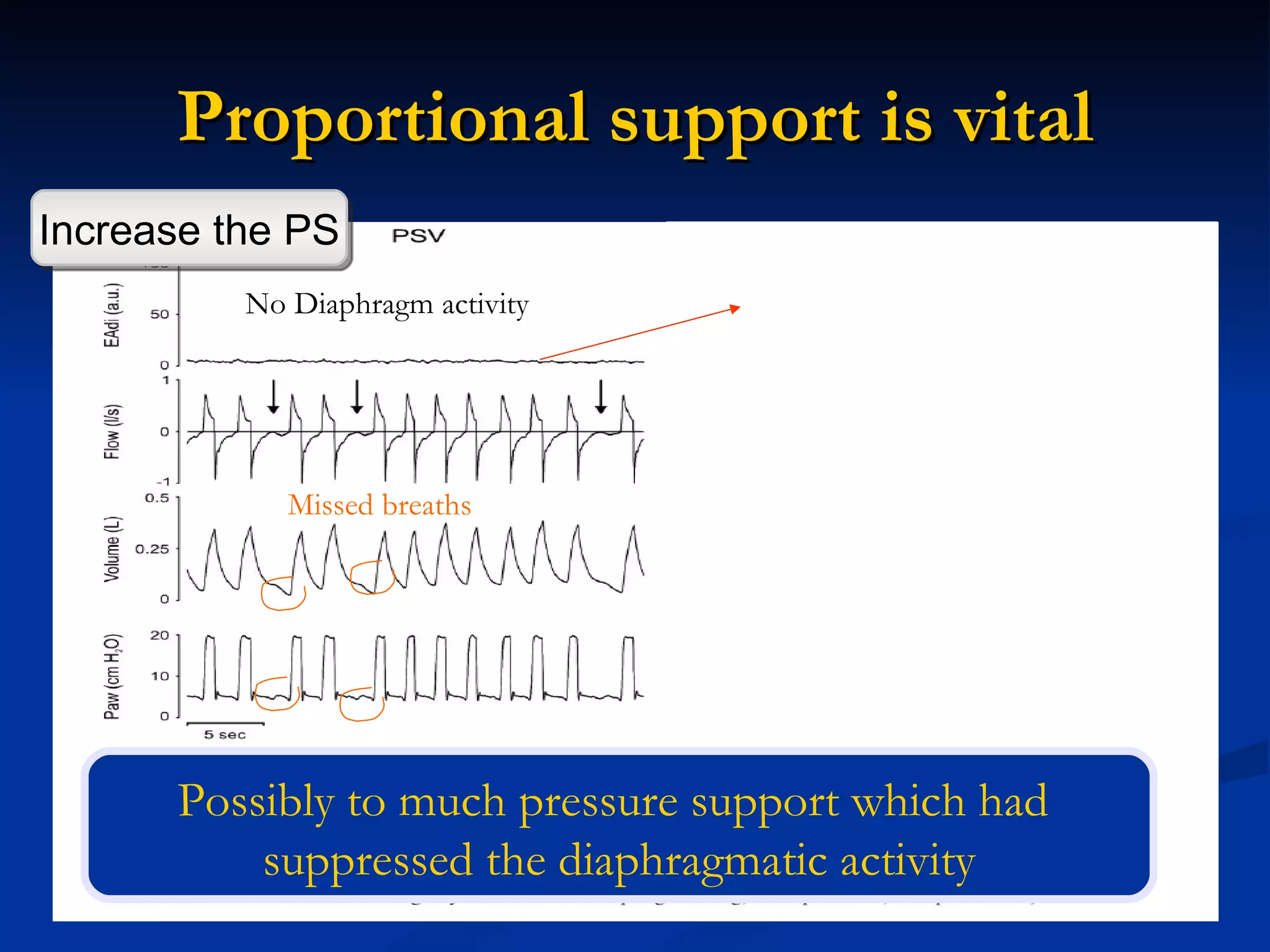 Proportional support is vital No Diaphragm activity Missed breaths Possibly to much pressure support which had  suppressed the diaphragmatic activity Increase the PS 