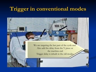Trigger in conventional modes We are targeting the last part of the cycle and  Also add the delay from the Y piece or the machine end Trigger delay is inbuilt in the old modes 