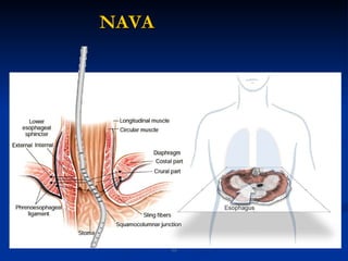 NAVA Esophagus 