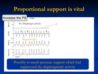 Proportional support is vital No Diaphragm activity Missed breaths Possibly to much pressure support which had  suppressed the diaphragmatic activity Increase the PS 