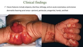 Clinical findings
 Classic features include alopecia, diarrhea, lethargy, and an acute eczematous and erosive
dermatitis favoring acral areas—perioral, periocular, anogenital, hands, and feet
 