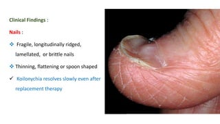 Clinical Findings :
Nails :
 Fragile, longitudinally ridged,
lamellated, or brittle nails
 Thinning, flattening or spoon shaped
 Koilonychia resolves slowly even after
replacement therapy
 