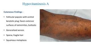 Hypovitaminosis A
Cutaneous Findings :
• Follicular papules with central
keratotic plug; favors extensor
surfaces of extremities, buttocks
• Generalized xerosis
• Sparse, fragile hair
• Squamous metaplasia
 