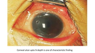 Corneal ulcer upto ¾ depth is one of characteristic finding
 