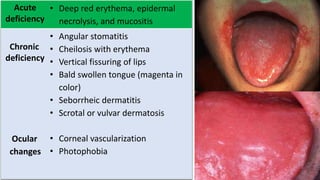 Acute
deficiency
• Deep red erythema, epidermal
necrolysis, and mucositis
Chronic
deficiency
Ocular
changes
• Angular stomatitis
• Cheilosis with erythema
• Vertical fissuring of lips
• Bald swollen tongue (magenta in
color)
• Seborrheic dermatitis
• Scrotal or vulvar dermatosis
• Corneal vascularization
• Photophobia
 