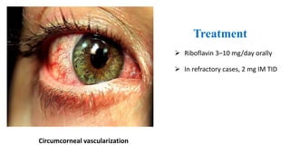 Circumcorneal vascularization
Treatment
 Riboflavin 3–10 mg/day orally
 In refractory cases, 2 mg IM TID
 