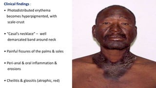 Clinical findings :
• Photodistributed erythema
becomes hyperpigmented, with
scale-crust
• “Casal’s necklace” – well
demarcated band around neck
• Painful fissures of the palms & soles
• Peri-anal & oral inflammation &
erosions
• Cheilitis & glossitis (atrophic, red)
 