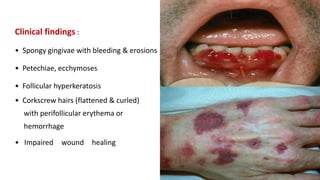 Clinical findings :
• Spongy gingivae with bleeding & erosions
• Petechiae, ecchymoses
• Follicular hyperkeratosis
• Corkscrew hairs (flattened & curled)
with perifollicular erythema or
hemorrhage
• Impaired wound healing
 