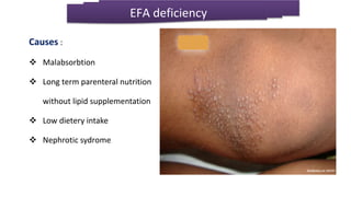 Causes :
 Malabsorbtion
 Long term parenteral nutrition
without lipid supplementation
 Low dietery intake
 Nephrotic sydrome
EFA deficiency
 