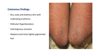 Cutaneous findings :
 Dry, scaly and leathery skin with
underlying erythema
 Follicular Hyperkeratosis
 Intertriginous erosions
 Alopecia and more lightly pigmented
hair
 