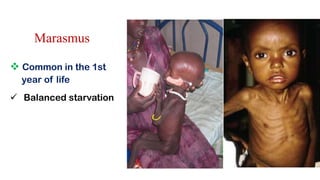 Marasmus
 Common in the 1st
year of life
 Balanced starvation
 