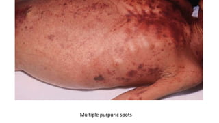 Multiple purpuric spots
 