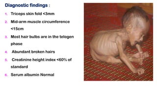 Diagnostic findings :
1. Triceps skin fold <3mm
2. Mid-arm muscle circumference
<15cm
3. Most hair bulbs are in the telogen
phase
4. Abundant broken hairs
5. Creatinine height index <60% of
standard
6. Serum albumin Normal
 