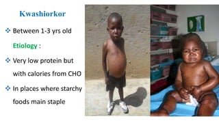 Kwashiorkor
 Between 1-3 yrs old
Etiology :
 Very low protein but
with calories from CHO
 In places where starchy
foods main staple
 