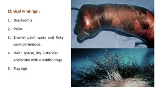 Clinical Findings :
1. Dyschromia
2. Pallor
3. Enamel paint spots and flaky
paint dermatosis.
4. Hair : sparse, dry, lusterless
and brittle with a reddish tinge
5. Flag sign
 