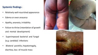 Systemic findings :
• Relatively well-nourished appearance
• Edema or even anasarca
• Apathy, anorexia, irritability
• Failure to thrive (retardation of growth
and mental development)
• Superimposed bacterial and fungal
(e.g. candidal) infections
• Bilateral parotitis, hepatomegaly,
diarrhea, loss of muscle mass
 