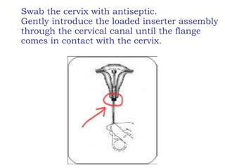 Swab the cervix with antiseptic. Gently introduce the loaded inserter assembly through the cervical canal until the flange comes in contact with the cervix. 