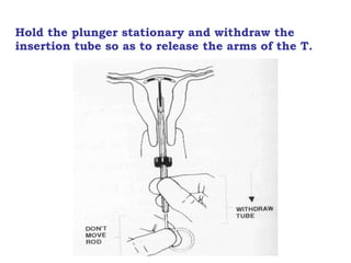 Hold the plunger stationary and withdraw the insertion tube so as to release the arms of the T. 