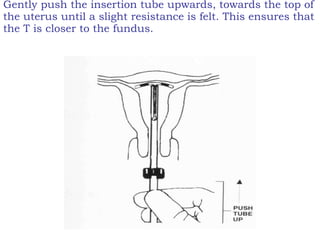 Gently push the insertion tube upwards, towards the top of the uterus until a slight resistance is felt. This ensures that the T is closer to the fundus.  
