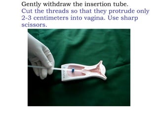 Gently withdraw the insertion tube. Cut the threads so that they protrude only 2-3 centimeters into vagina. Use sharp scissors. 