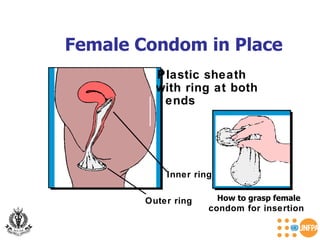 Female Condom in Place   Inner ring Outer ring Plastic sheath with ring at both ends How to grasp female condom for insertion 