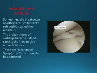 Instability and
Arthritis
 