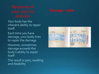 Response of
your Joint to
Arthritis
Damage = pain
 