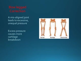 Bow legged
Correction
 