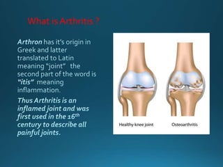 What is Arthritis ?
 