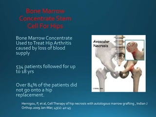 Bone Marrow
Concentrate Stem
Cell For Hips
Hernigou, P, et al, Cell Therapy of hip necrosis with autologous marrow grafting , Indian J
Orthop.2009 Jan-Mar; 43(1): 40-45
 