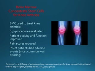 Bone Marrow
Concentrate Stem Cells
for Knee Arthritis
Centeno C, et al, Efficacy of autologous bone marrow concentrate for knee osteoarthritis with and
without adipose graft, Biomed Res Int. 2014;2014:370621
 