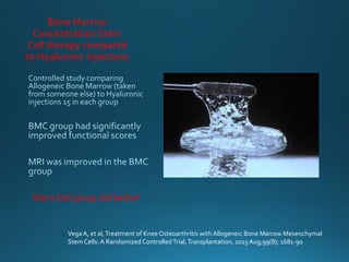 Bone Marrow
Concentration Stem
Cell therapy compared
to Hyaluronic Injections
Stem Cell group did better!
Vega A, et al,Treatment of KneeOsteoarthritis with Allogeneic Bone Marrow Mesenchymal
Stem Cells: A Randomized ControlledTrial,Transplantation, 2015Aug;99(8); 1681-90
 