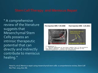 Stem CellTherapy and Meniscus Repair
HanaYu, et al, Meniscus repair using mesenchymal stem cells- a comprehensive review, Stem Cell
ResTher. 2015; 6(1): 86.
 