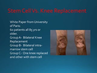 Stem CellVs. Knee Replacement
 