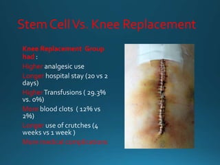 Stem CellVs. Knee Replacement
Knee Replacement Group
had
Higher
Longer
Higher
More
Longer
More medical complications
 