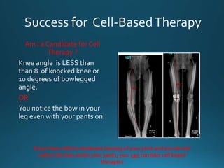 Am I a Candidate forCell
Therapy ?
OR
If you have mild to moderate bowing of your joint and you do not
notice the bow under your pants, you can consider cell based
therapies
 