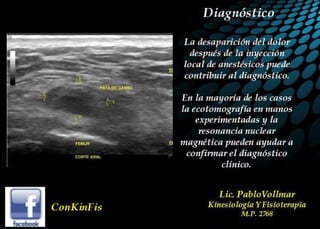 Tendinitis Pata de Ganso