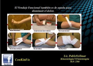 Tendinitis Pata de Ganso