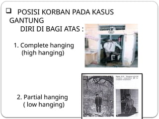 Forensic Analysis of Hanging: Mechanisms, Signs, and Medico-legal ...
