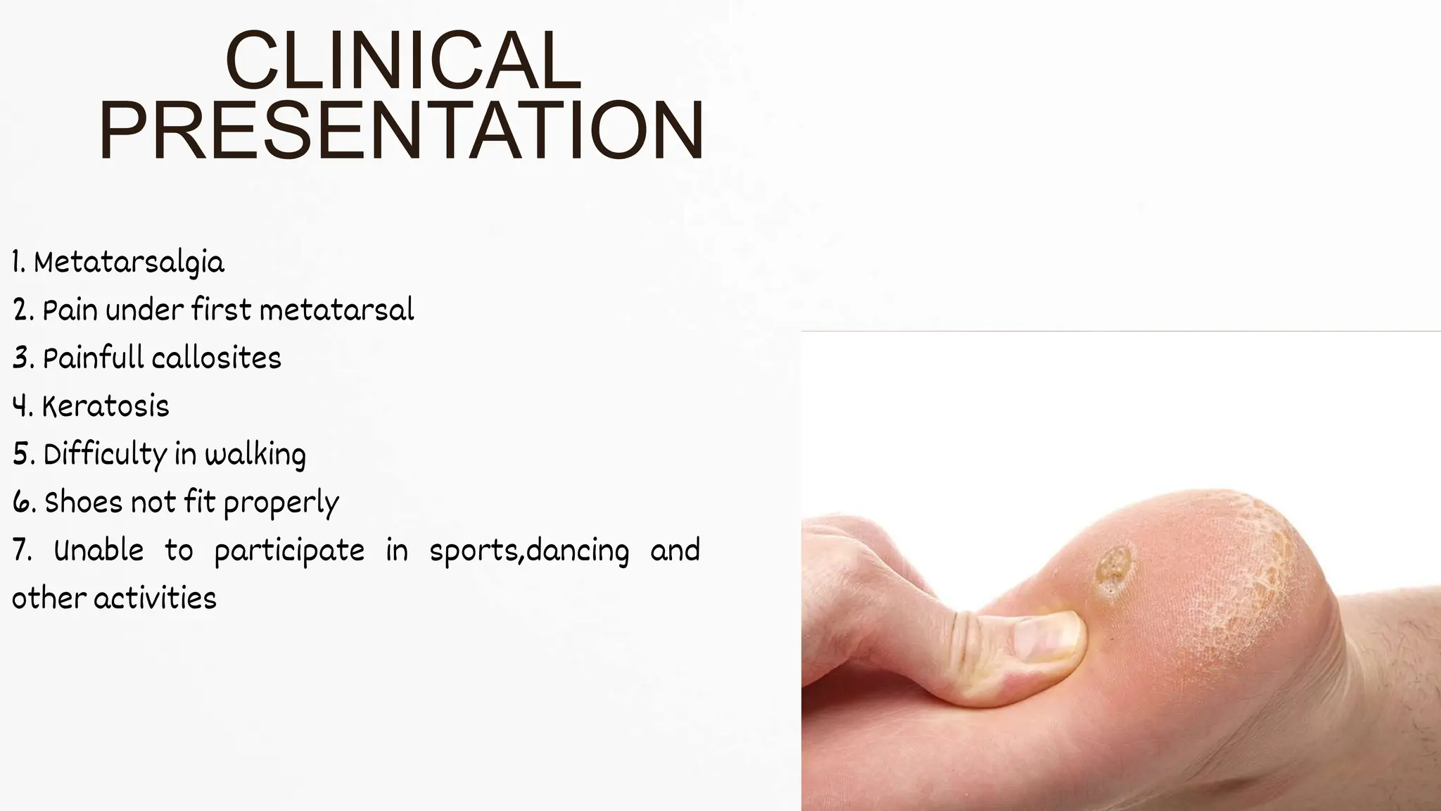1. Metatarsalgia
2. Pain under first metatarsal
3. Painfull callosites
4. Keratosis
5. Difficulty in walking
6. Shoes not fit properly
7. Unable to participate in sports,dancing and
other activities
CLINICAL
PRESENTATION
 