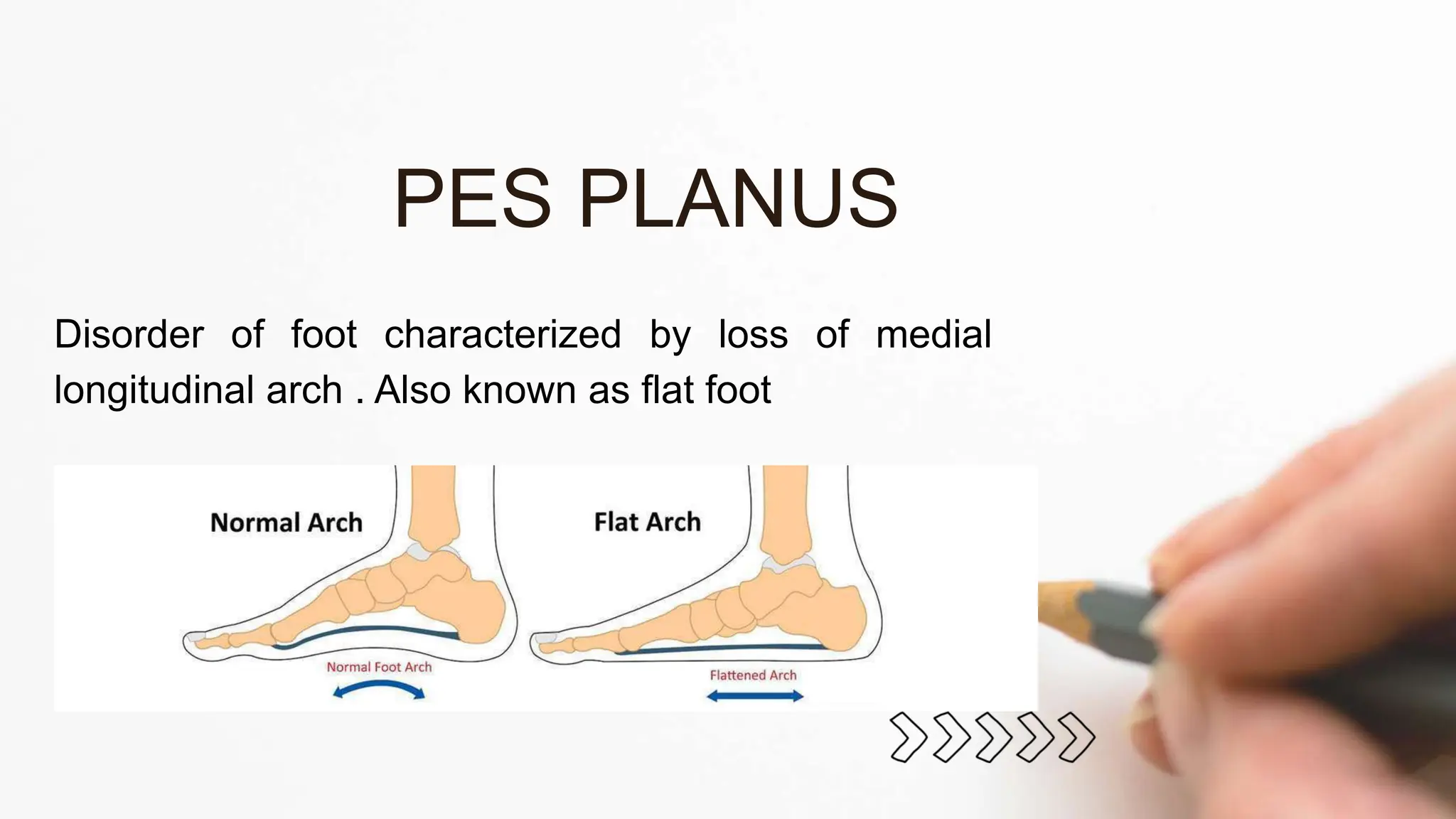 Disorder of foot characterized by loss of medial
longitudinal arch . Also known as flat foot
PES PLANUS
 