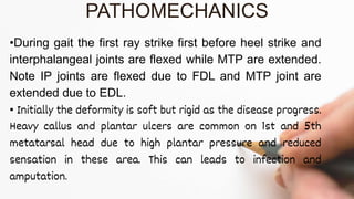 •During gait the first ray strike first before heel strike and
interphalangeal joints are flexed while MTP are extended.
Note IP joints are flexed due to FDL and MTP joint are
extended due to EDL.
• Initially the deformity is soft but rigid as the disease progress.
Heavy callus and plantar ulcers are common on 1st and 5th
metatarsal head due to high plantar pressure and reduced
sensation in these area. This can leads to infection and
amputation.
PATHOMECHANICS
 