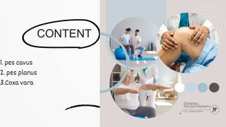 CONTENT
1. pes cavus
2. pes planus
3.Coxa vara
 