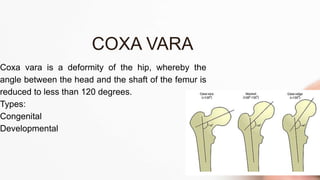 Coxa vara is a deformity of the hip, whereby the
angle between the head and the shaft of the femur is
reduced to less than 120 degrees.
Types:
Congenital
Developmental
COXA VARA
 