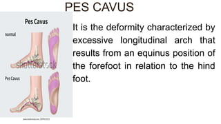 It is the deformity characterized by
excessive longitudinal arch that
results from an equinus position of
the forefoot in relation to the hind
foot.
PES CAVUS
 