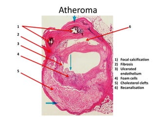 Atheroma
1                       6

2

3

4
               1) Focal calcification
               2) Fibrosis
               3) Ulcerated
5
                  endothelium
               4) Foam cells
               5) Cholesterol clefts
               6) Recanalisation
 